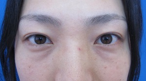目の下のたるみ、目のくまでお悩みの方、切らずに完璧に解決します。TCB-R法　手術直後　症例写真